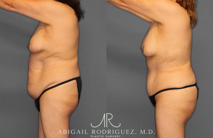 Before & After Tummy Tuck Case 258177 View 3 View in Houston, TX