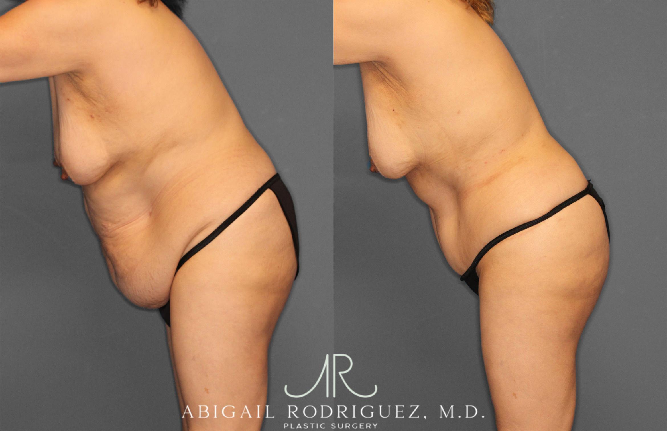 Before & After Tummy Tuck Case 258177 View 4 View in Houston, TX