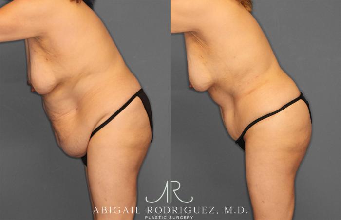 Before & After Tummy Tuck Case 258177 View 4 View in Houston, TX
