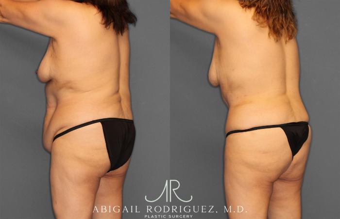 Before & After Tummy Tuck Case 258177 View 5 View in Houston, TX