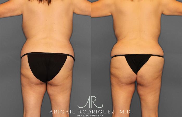 Before & After Tummy Tuck Case 258177 View 6 View in Houston, TX