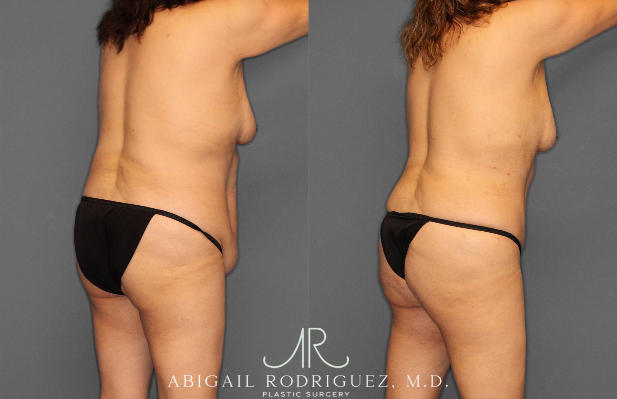 Before & After Tummy Tuck Case 258177 View 7 View in Houston, TX