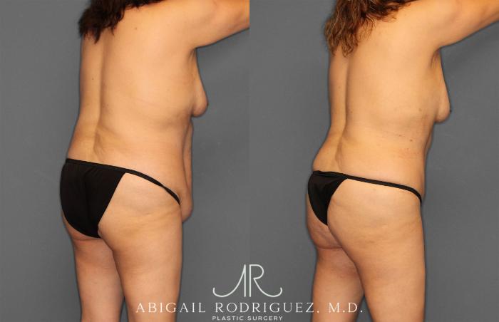 Before & After Tummy Tuck Case 258177 View 7 View in Houston, TX