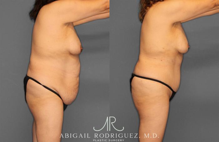Before & After Tummy Tuck Case 258177 View 8 View in Houston, TX