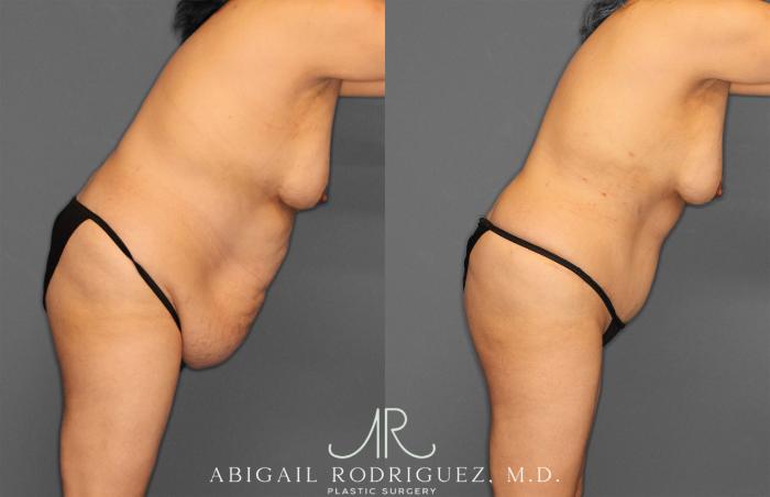 Before & After Tummy Tuck Case 258177 View 9 View in Houston, TX