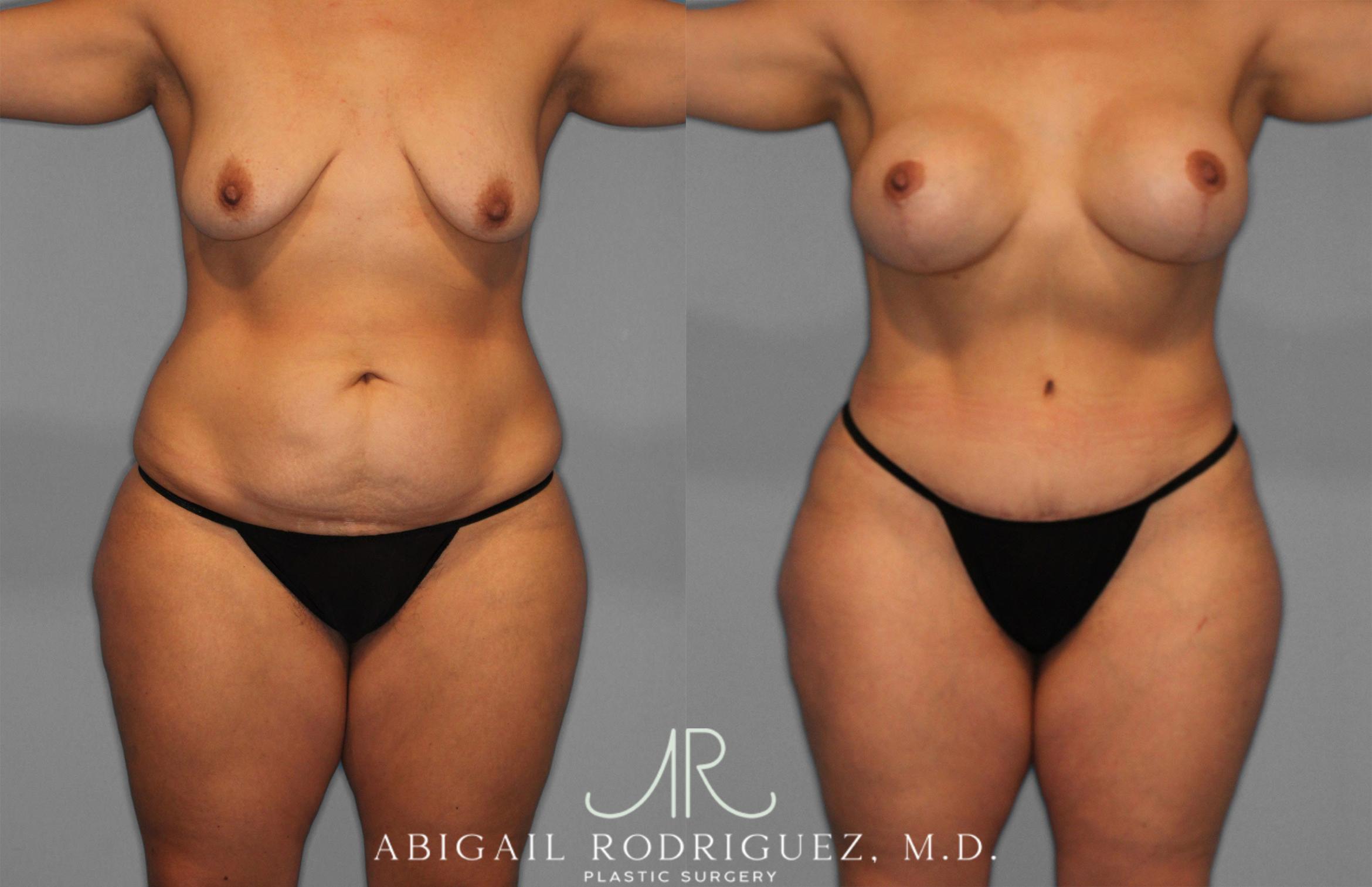 Before & After Tummy Tuck Case 258200 View 1 View in Houston, TX