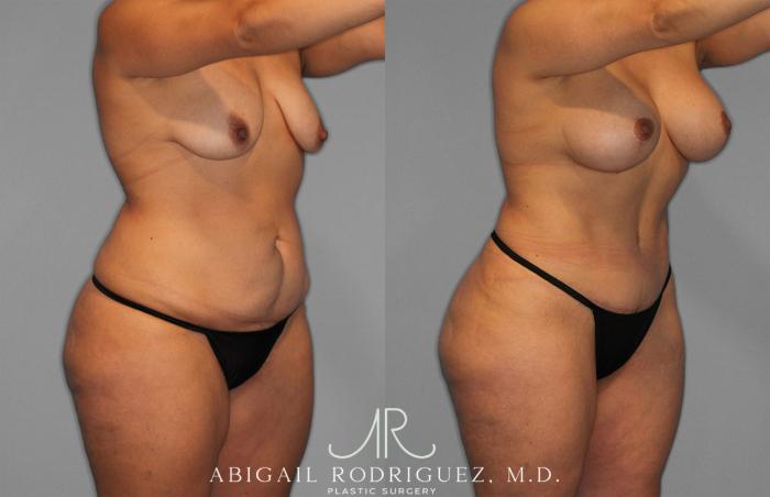 Before & After Tummy Tuck Case 258200 View 10 View in Houston, TX
