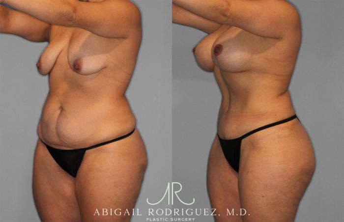 Before & After Tummy Tuck Case 258200 View 2 View in Houston, TX