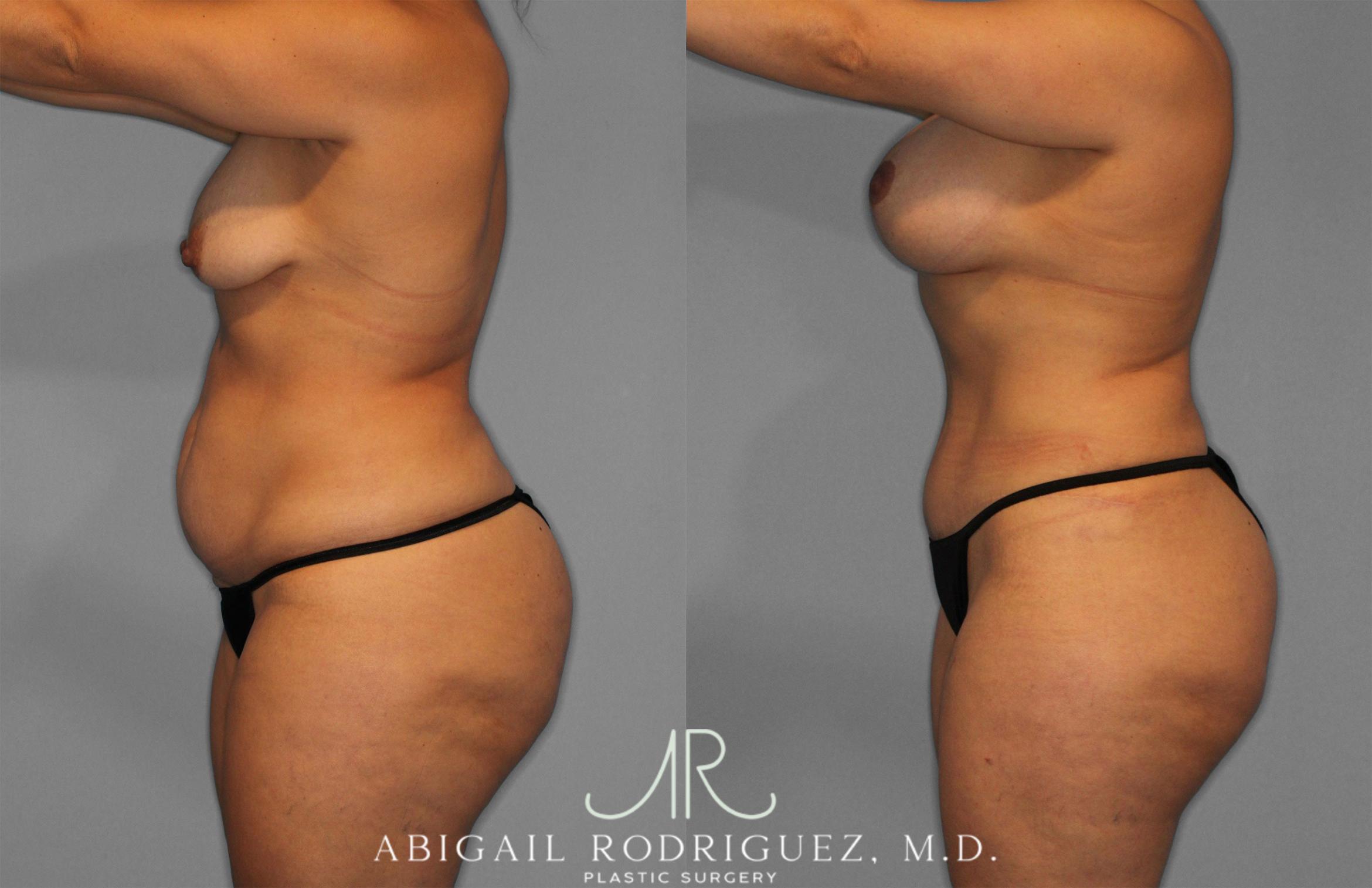 Before & After Tummy Tuck Case 258200 View 3 View in Houston, TX