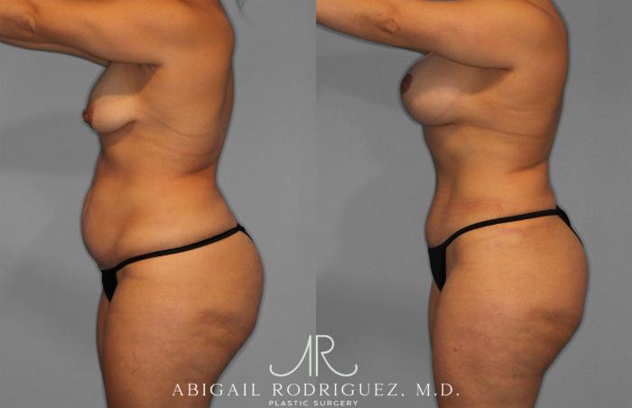 Before & After Tummy Tuck Case 258200 View 3 View in Houston, TX