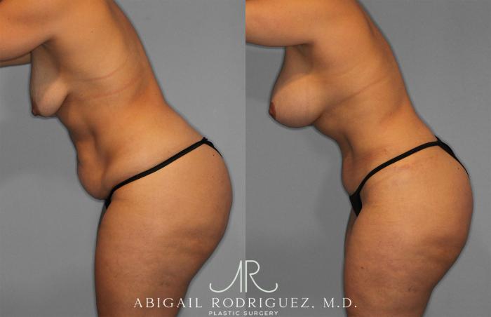 Before & After Tummy Tuck Case 258200 View 4 View in Houston, TX