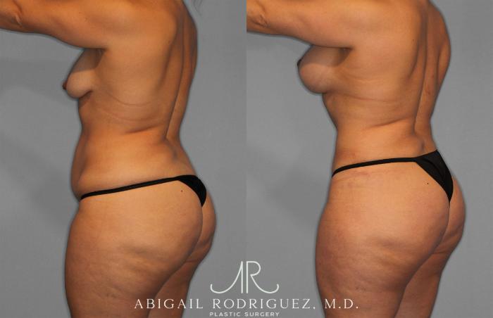 Before & After Tummy Tuck Case 258200 View 5 View in Houston, TX