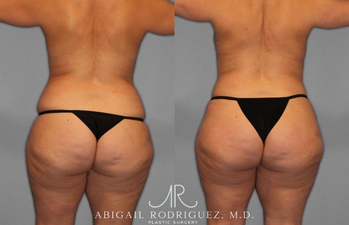 Before & After Tummy Tuck Case 258200 View 6 View in Houston, TX