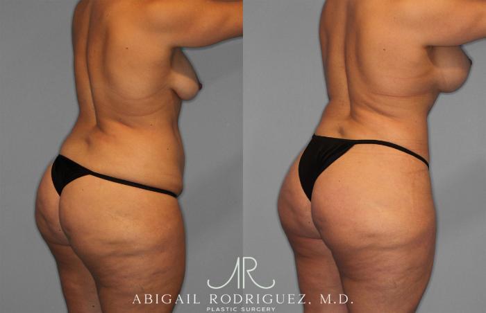 Before & After Tummy Tuck Case 258200 View 7 View in Houston, TX