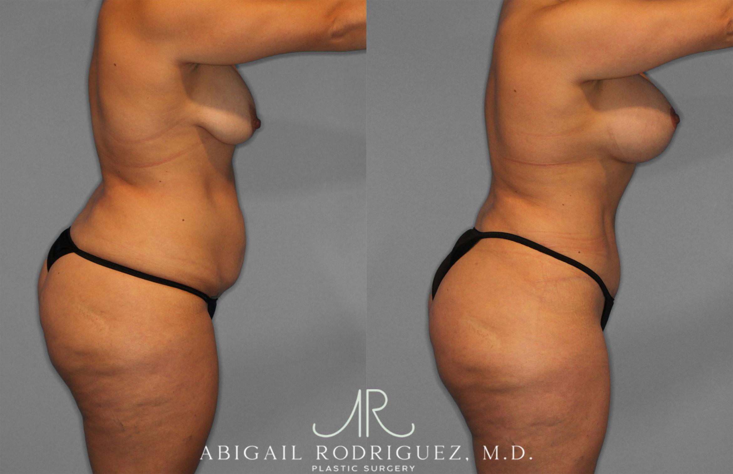 Before & After Tummy Tuck Case 258200 View 8 View in Houston, TX