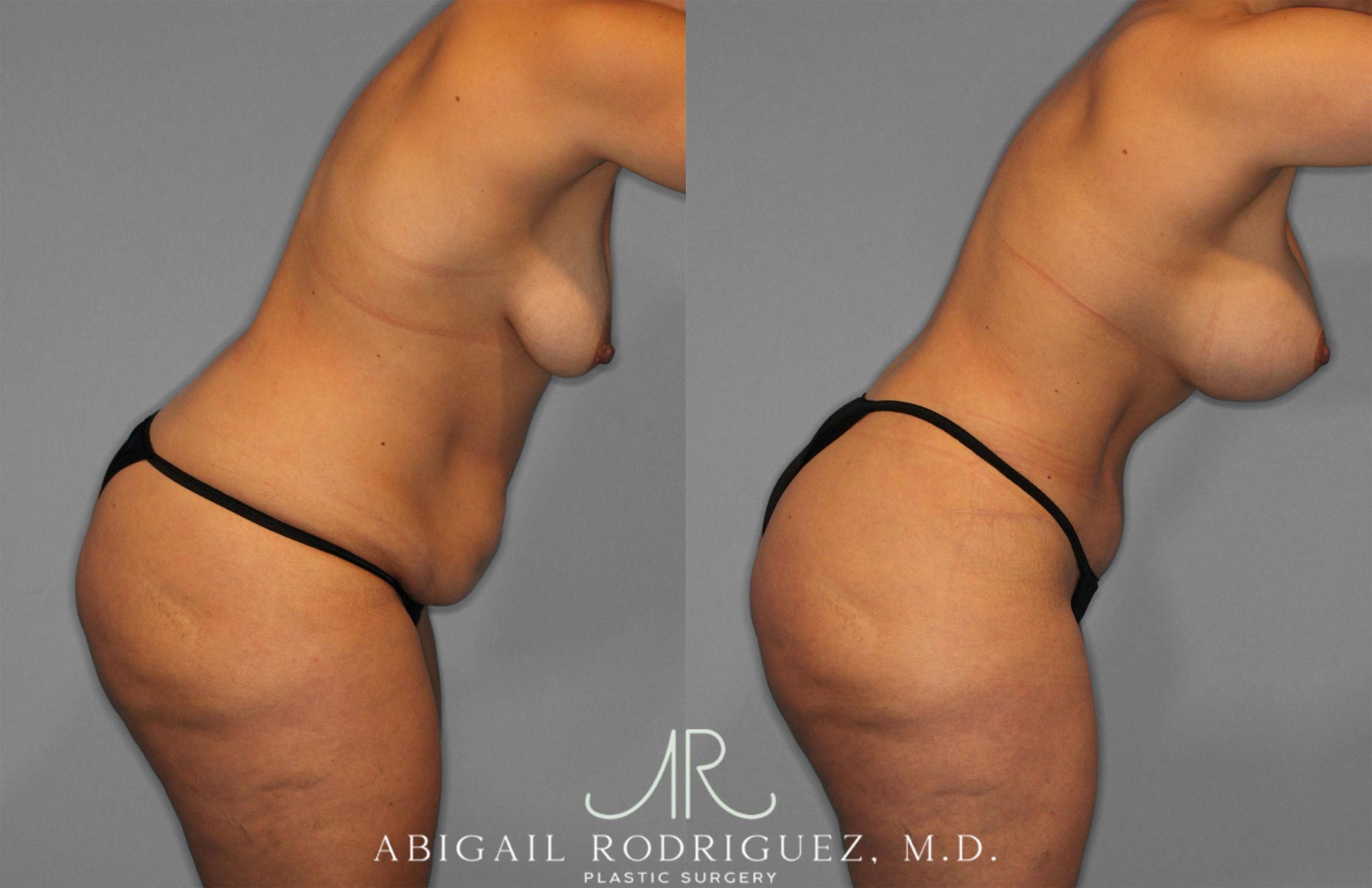 Before & After Tummy Tuck Case 258200 View 9 View in Houston, TX