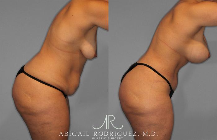Before & After Tummy Tuck Case 258200 View 9 View in Houston, TX