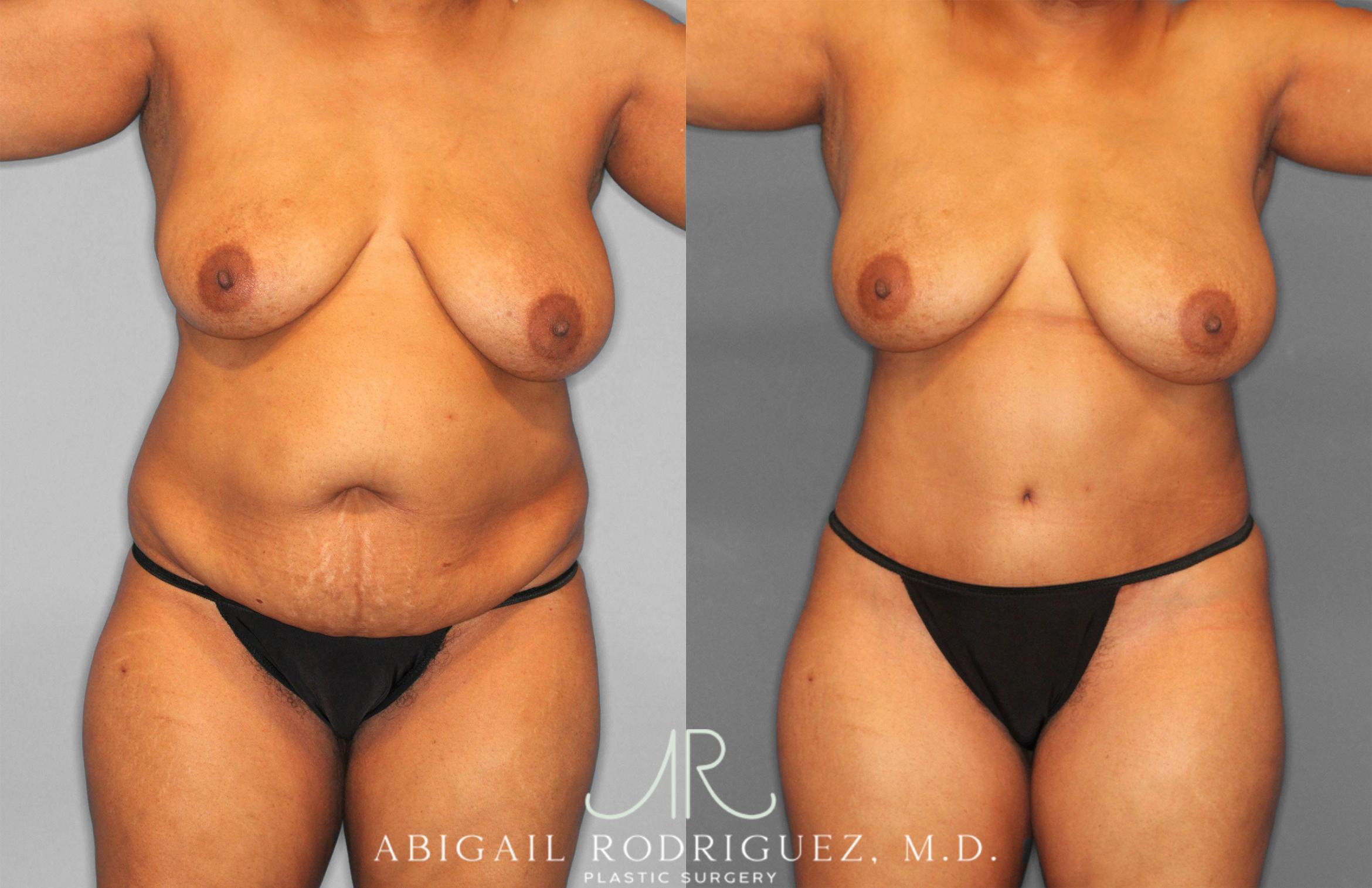 Before & After Tummy Tuck Case 258242 View 1 View in Houston, TX