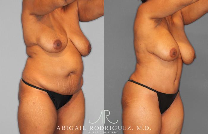 Before & After Tummy Tuck Case 258242 View 10 View in Houston, TX