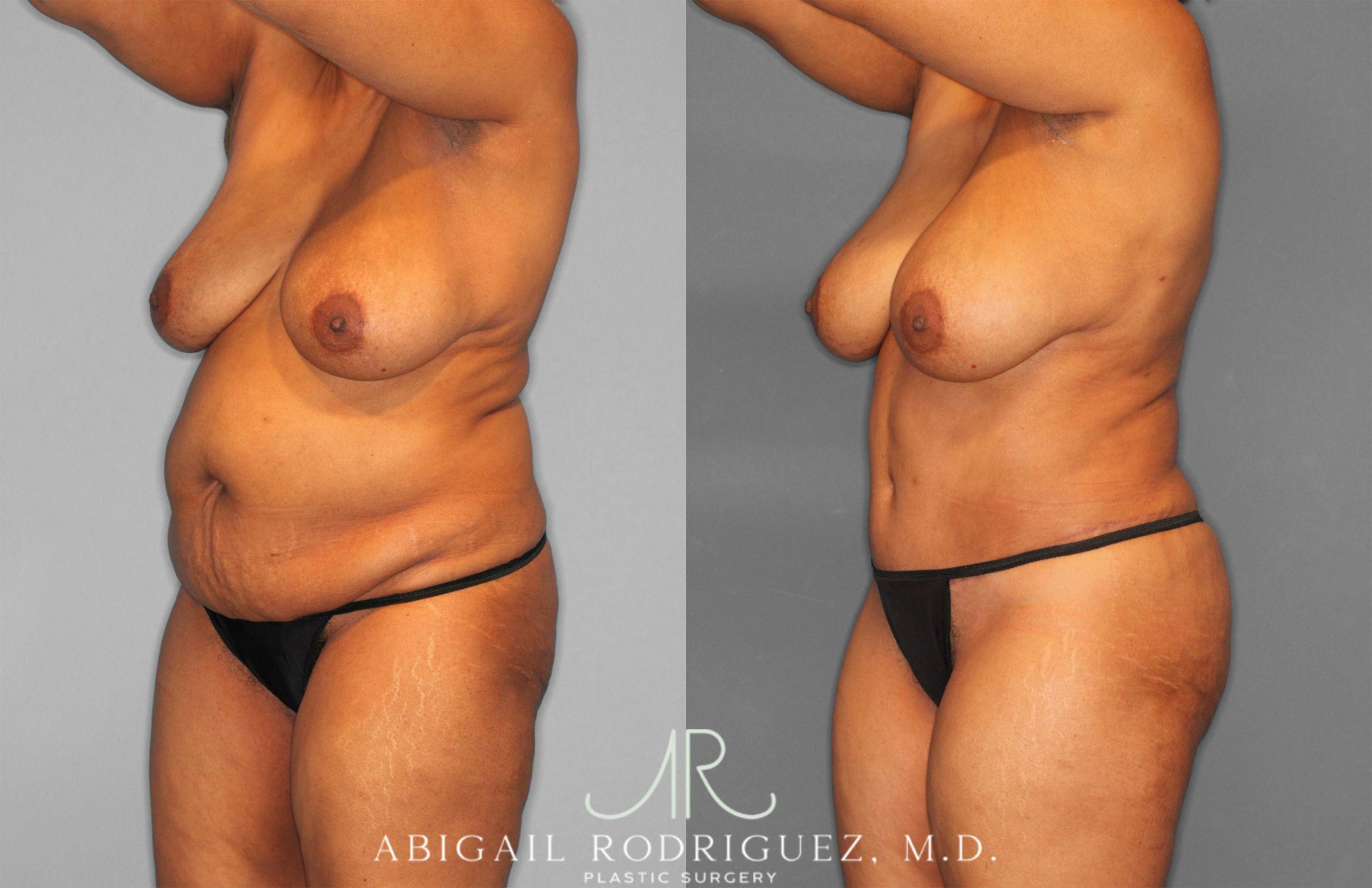 Before & After Tummy Tuck Case 258242 View 2 View in Houston, TX