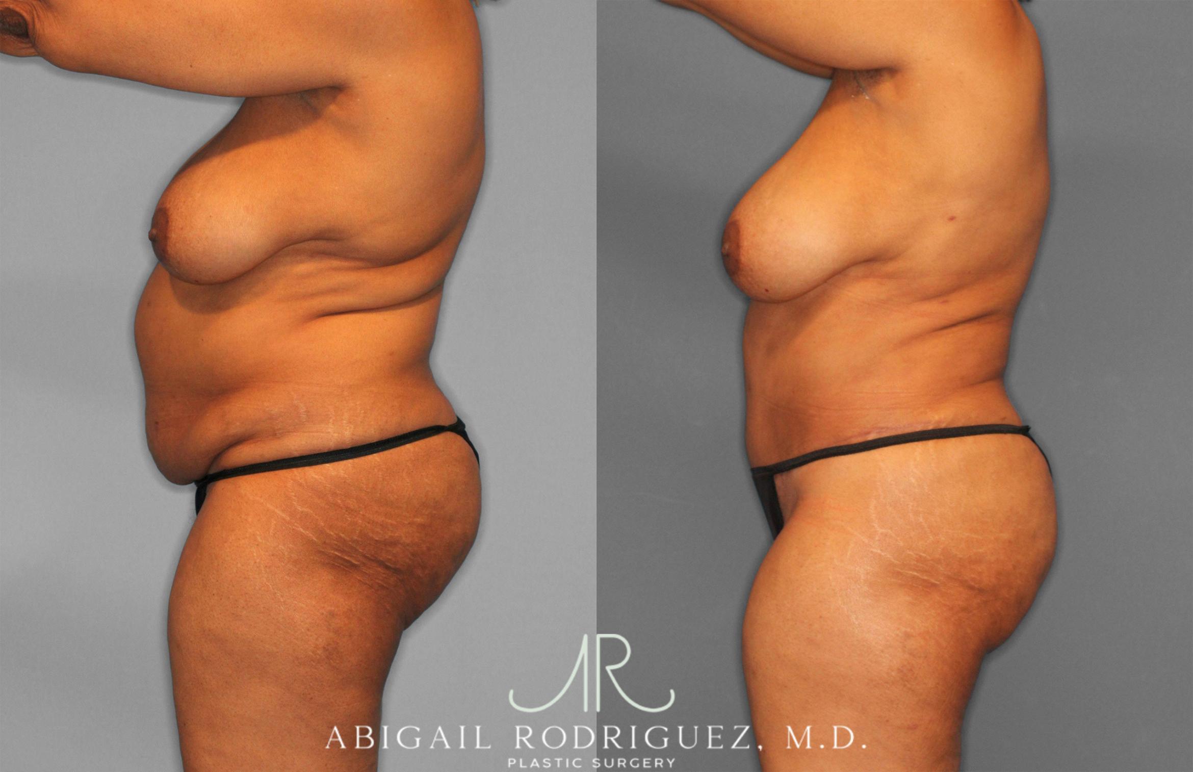 Before & After Tummy Tuck Case 258242 View 3 View in Houston, TX