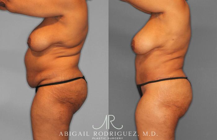 Before & After Tummy Tuck Case 258242 View 3 View in Houston, TX
