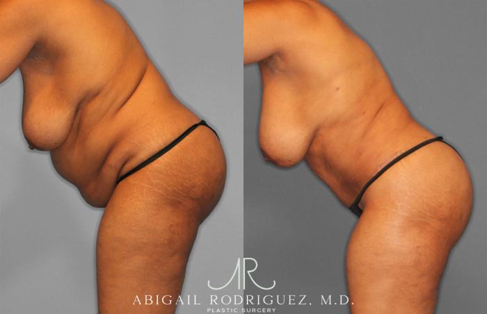Before & After Tummy Tuck Case 258242 View 4 View in Houston, TX