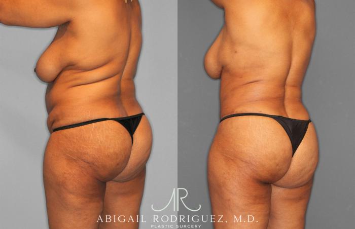 Before & After Tummy Tuck Case 258242 View 5 View in Houston, TX