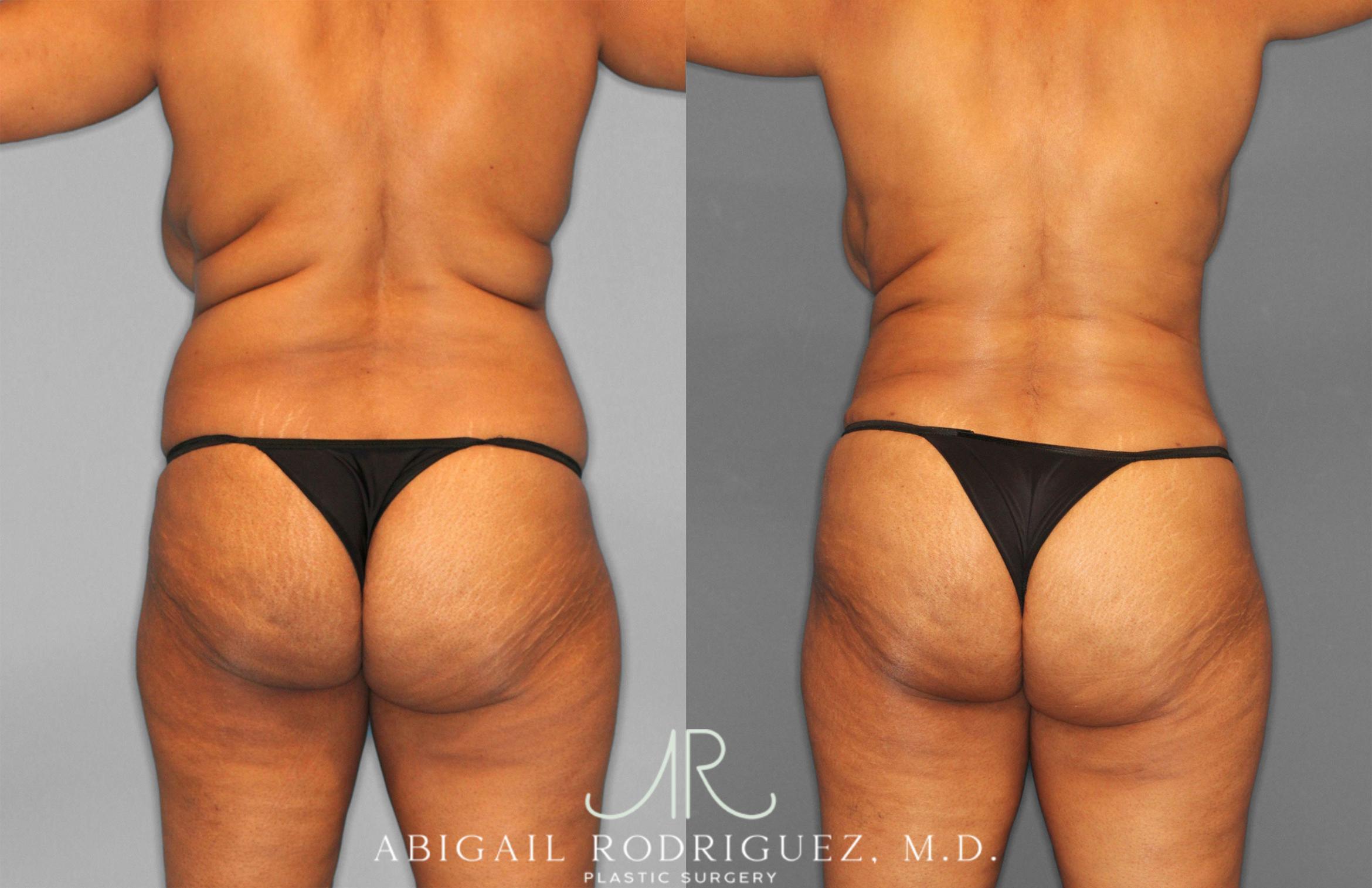 Before & After Tummy Tuck Case 258242 View 6 View in Houston, TX