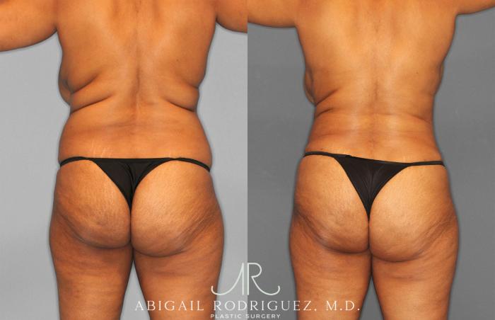 Before & After Tummy Tuck Case 258242 View 6 View in Houston, TX