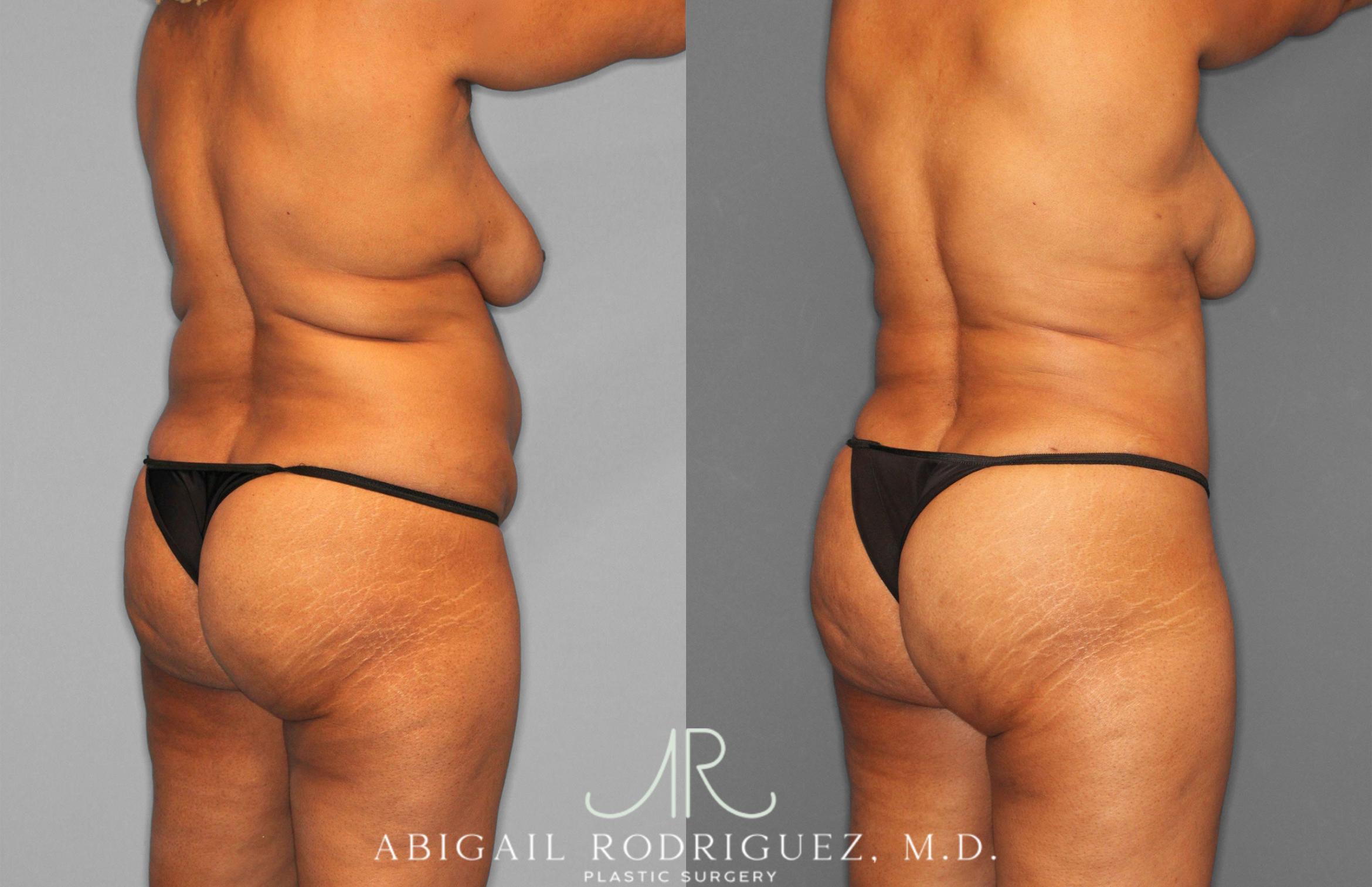 Before & After Tummy Tuck Case 258242 View 7 View in Houston, TX