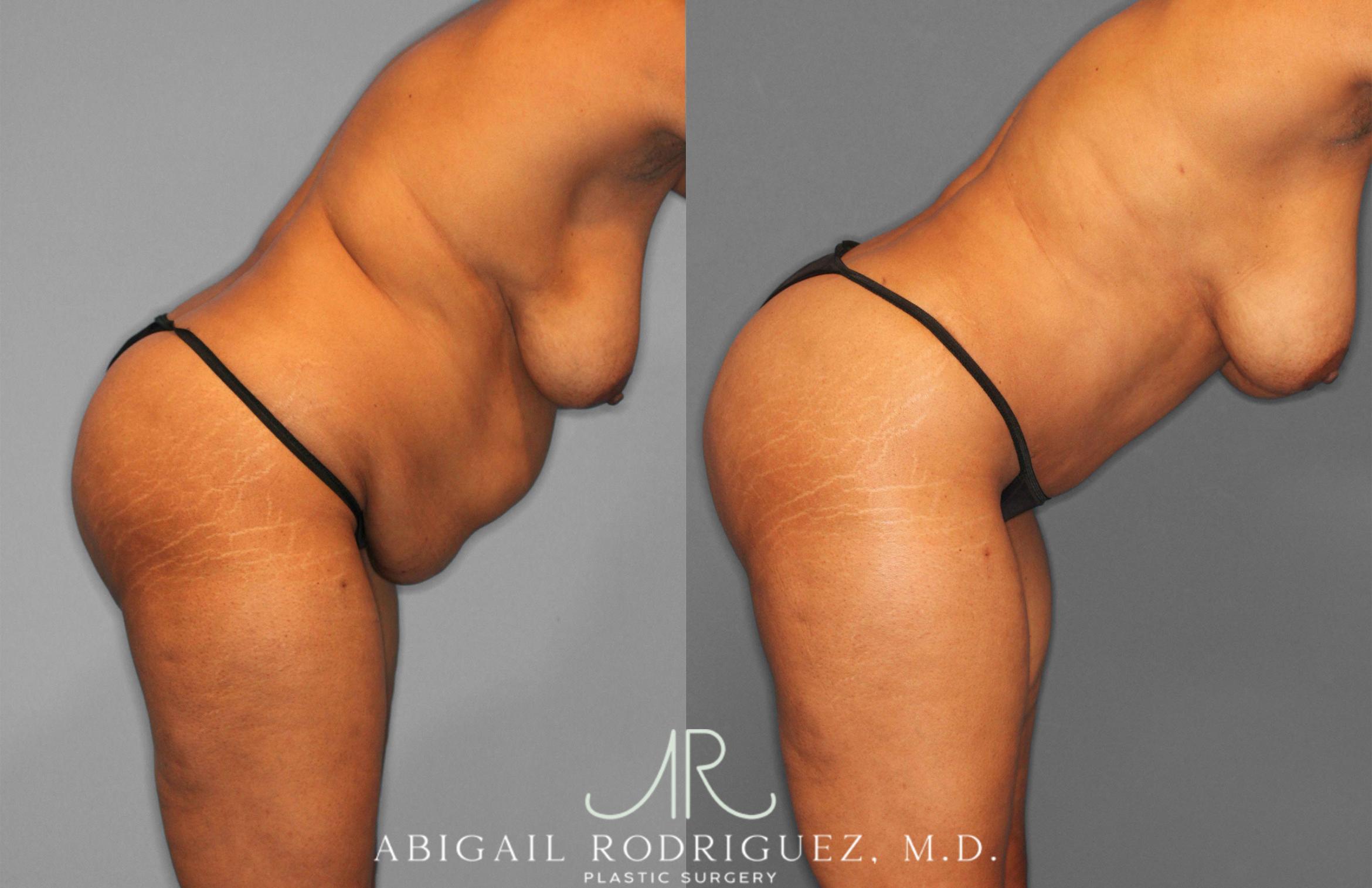 Before & After Tummy Tuck Case 258242 View 8 View in Houston, TX