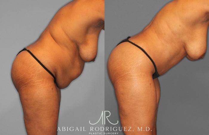 Before & After Tummy Tuck Case 258242 View 8 View in Houston, TX