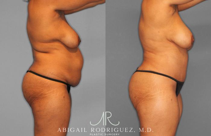 Before & After Tummy Tuck Case 258242 View 9 View in Houston, TX