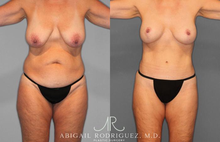 Before & After Tummy Tuck Case 258256 View 1 View in Houston, TX