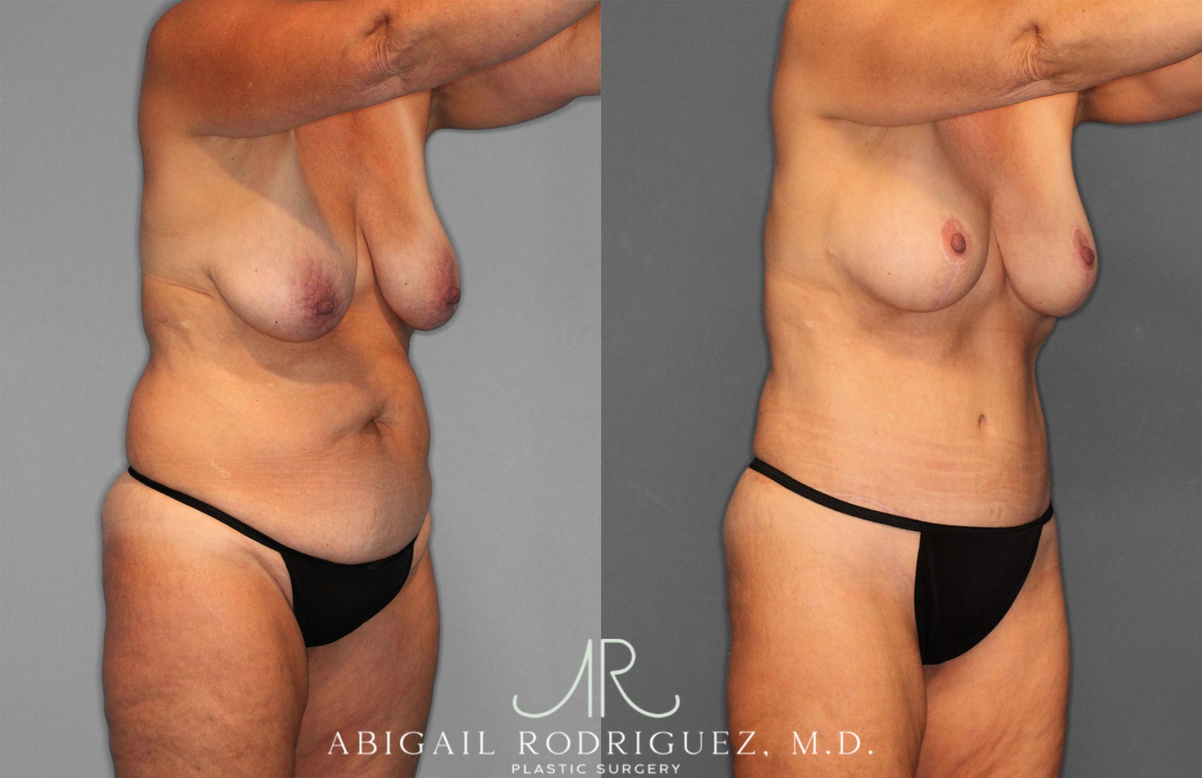 Before & After Tummy Tuck Case 258256 View 10 View in Houston, TX
