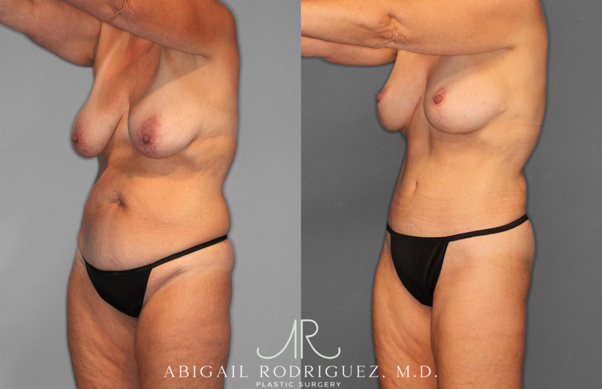 Before & After Tummy Tuck Case 258256 View 2 View in Houston, TX
