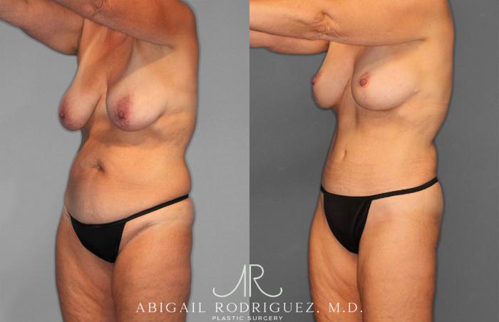 Before & After Tummy Tuck Case 258256 View 2 View in Houston, TX