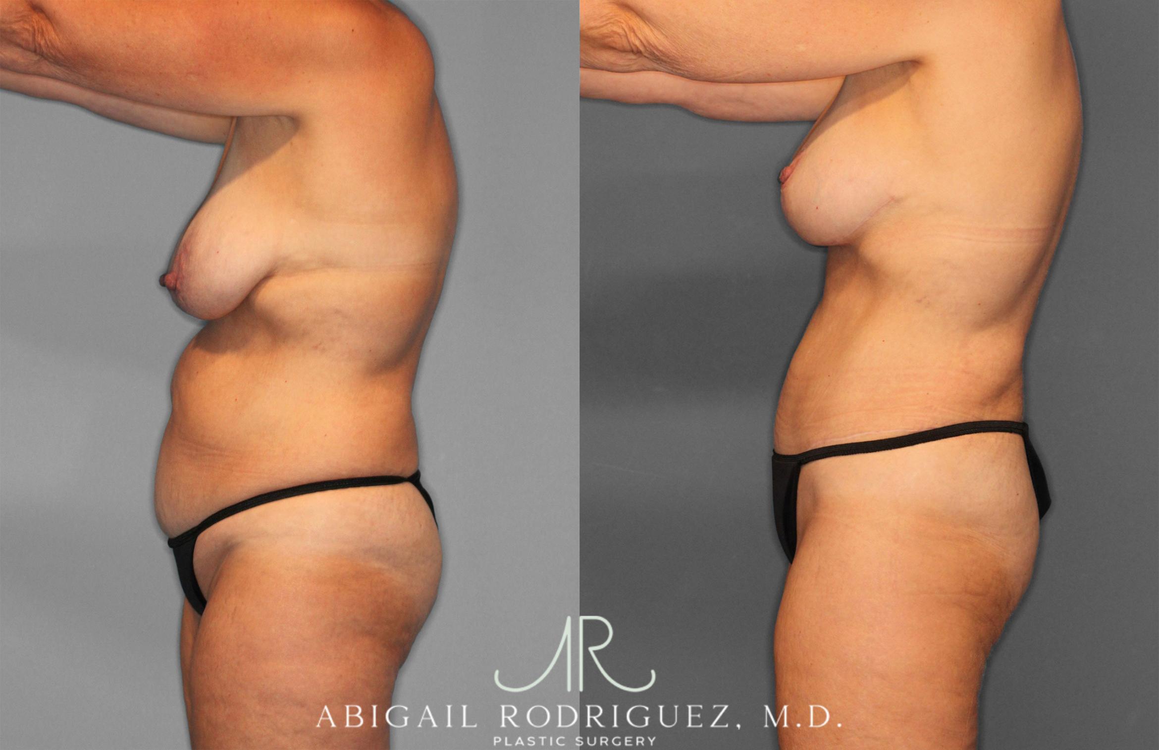 Before & After Tummy Tuck Case 258256 View 3 View in Houston, TX