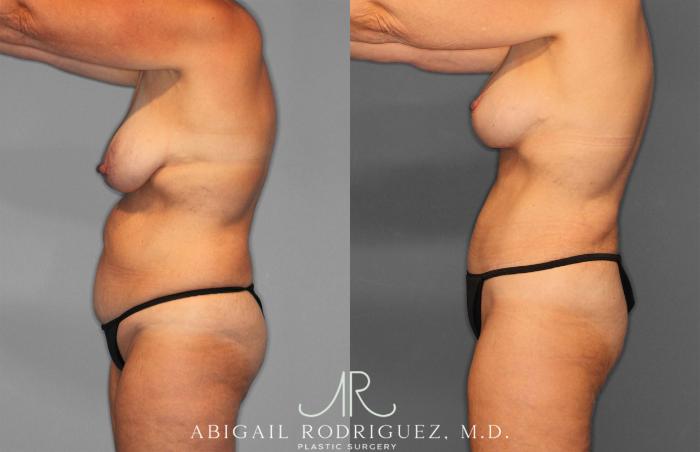 Before & After Tummy Tuck Case 258256 View 3 View in Houston, TX