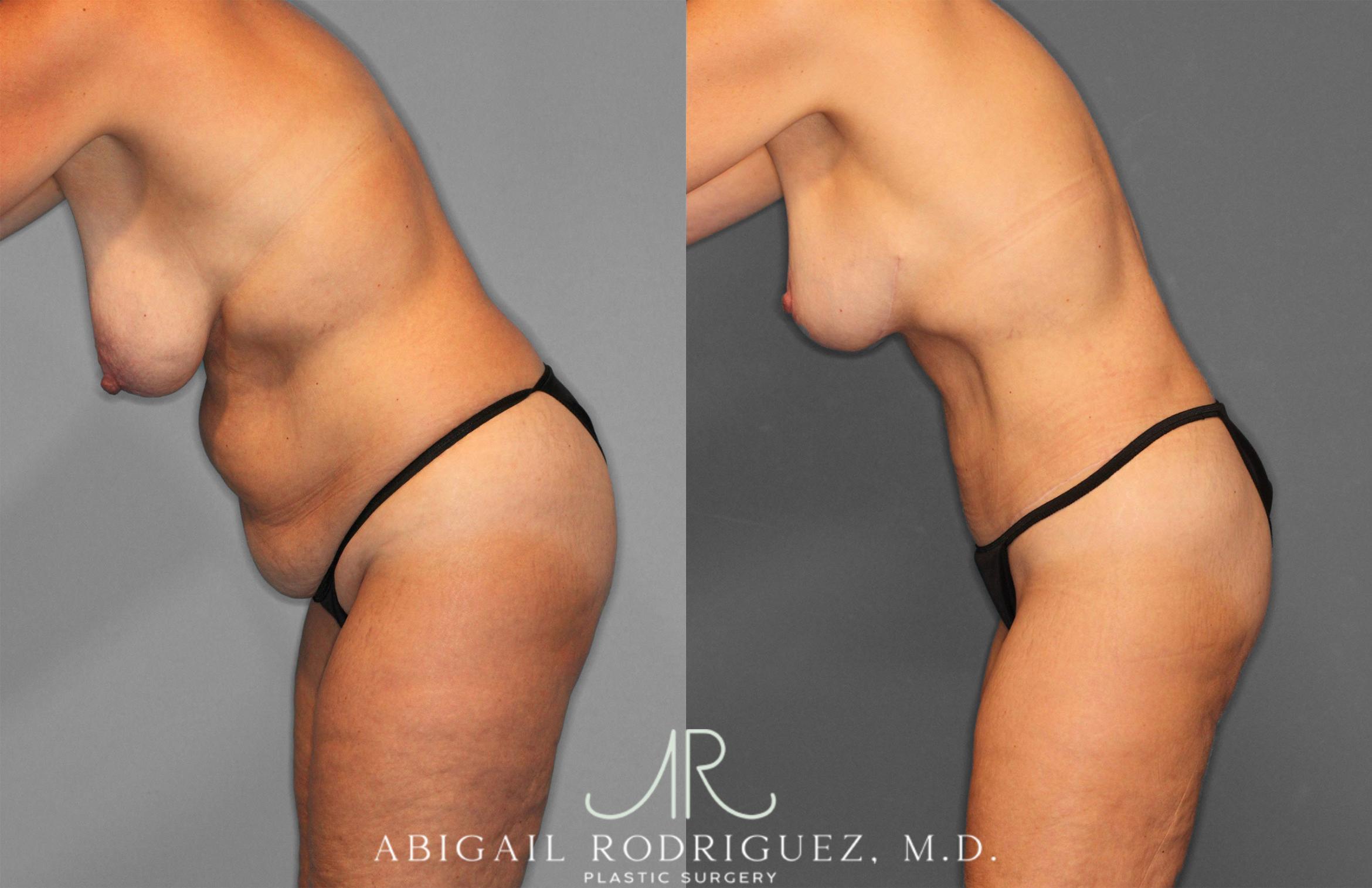 Before & After Tummy Tuck Case 258256 View 4 View in Houston, TX