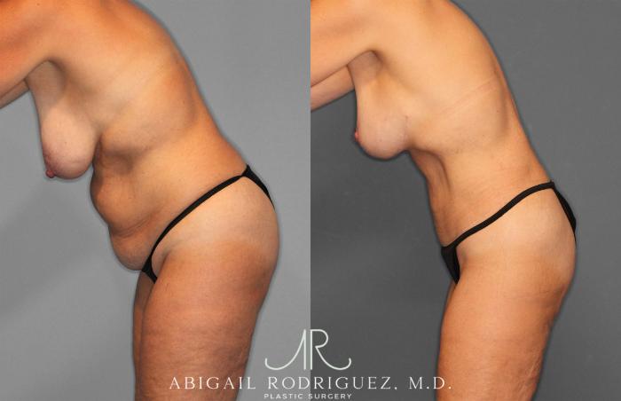 Before & After Tummy Tuck Case 258256 View 4 View in Houston, TX