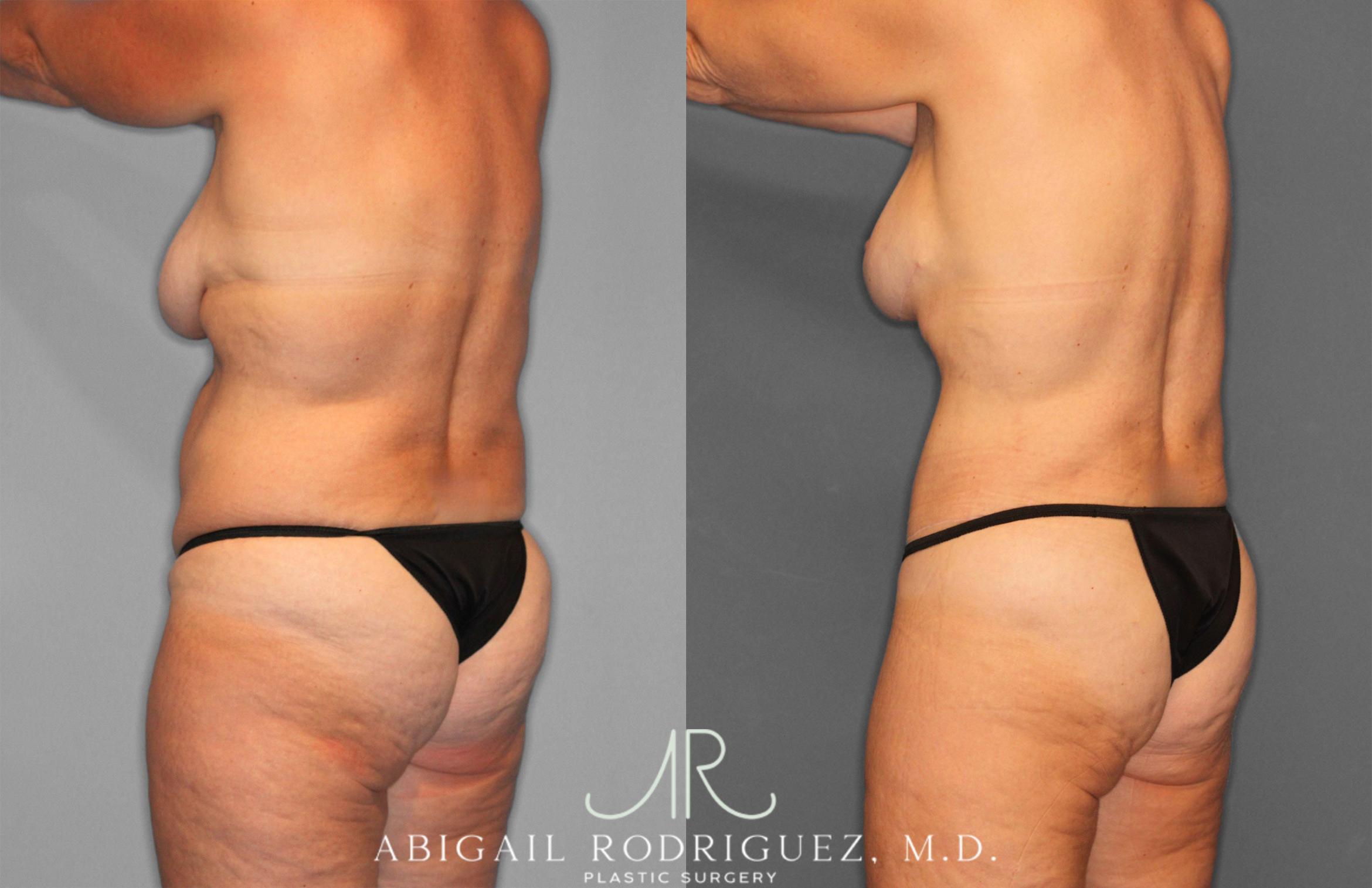 Before & After Tummy Tuck Case 258256 View 5 View in Houston, TX