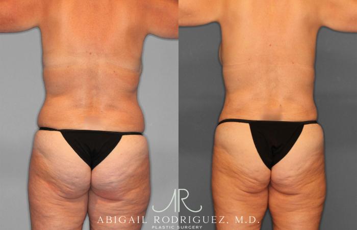 Before & After Tummy Tuck Case 258256 View 6 View in Houston, TX