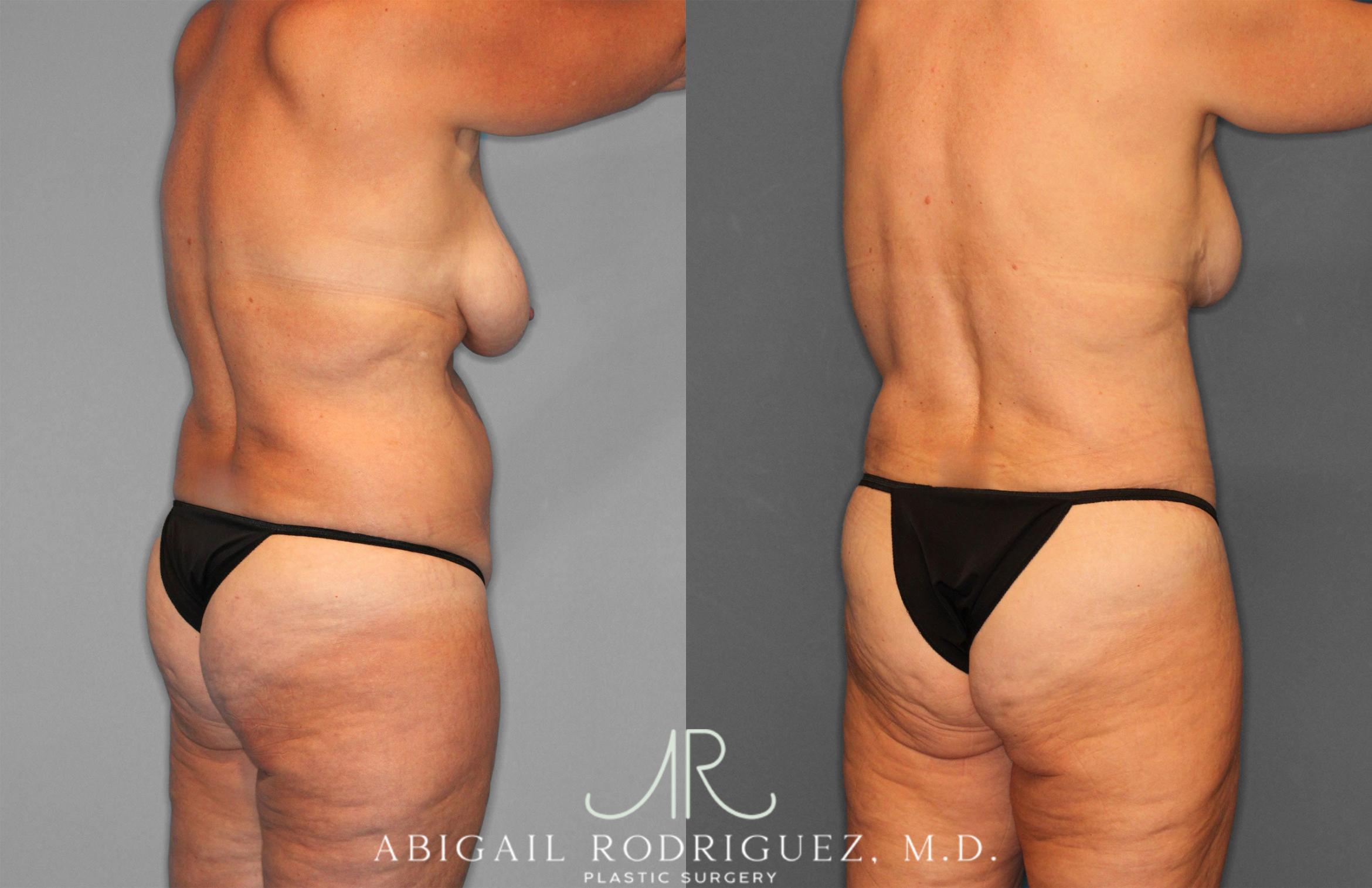 Before & After Tummy Tuck Case 258256 View 7 View in Houston, TX