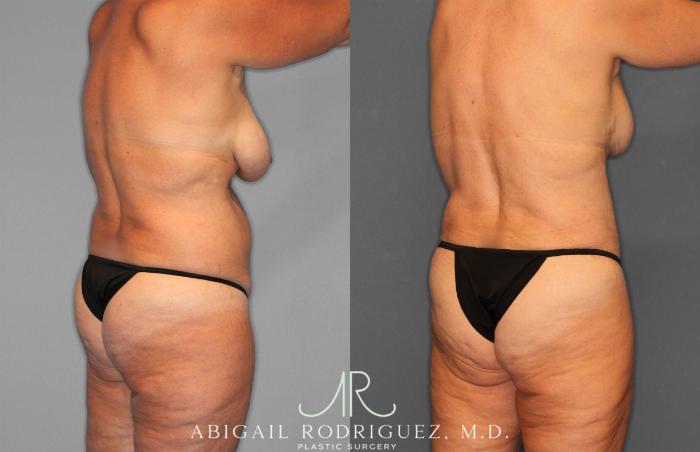 Before & After Tummy Tuck Case 258256 View 7 View in Houston, TX