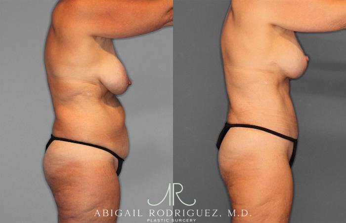 Before & After Tummy Tuck Case 258256 View 8 View in Houston, TX