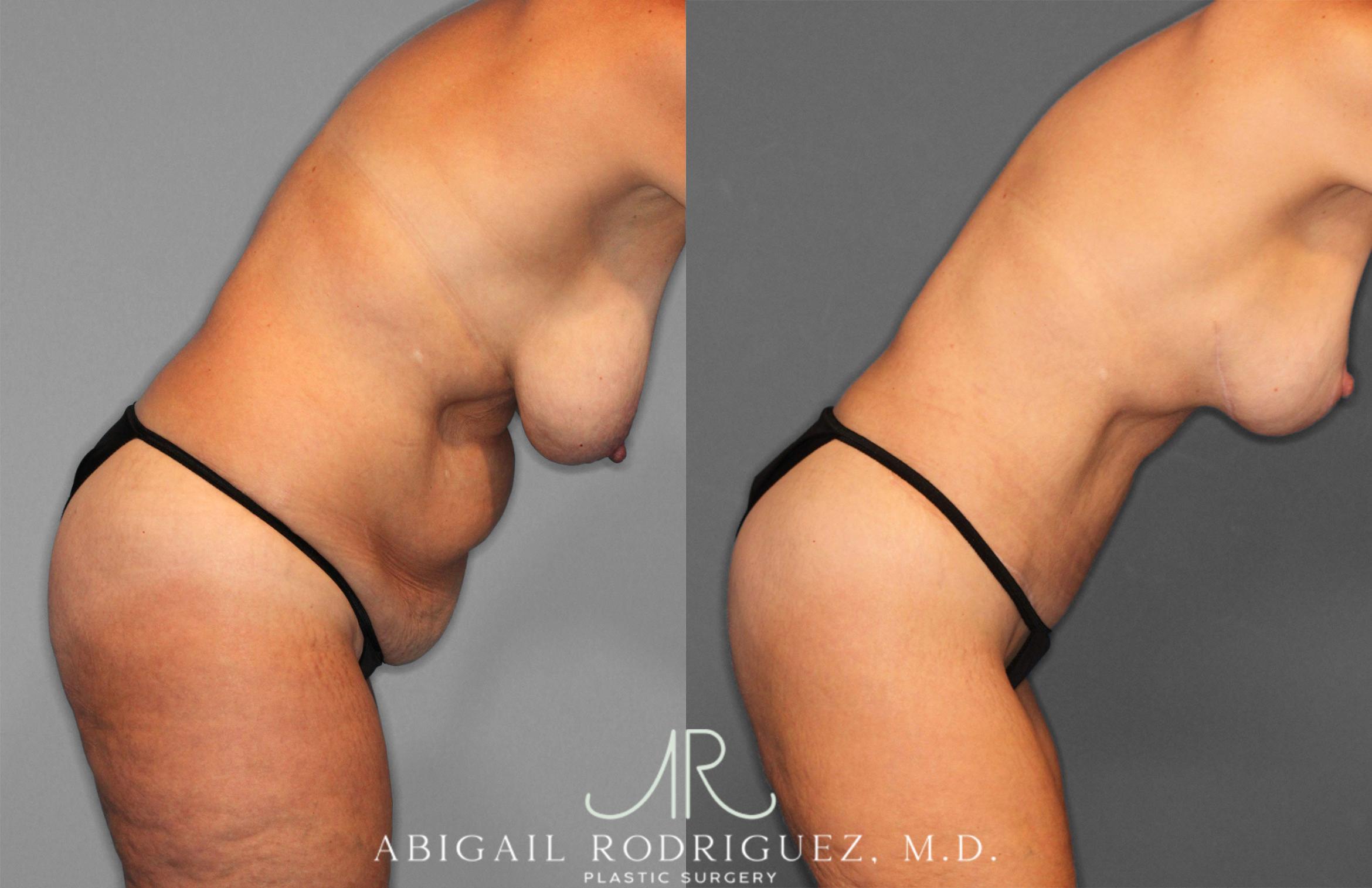 Before & After Tummy Tuck Case 258256 View 9 View in Houston, TX