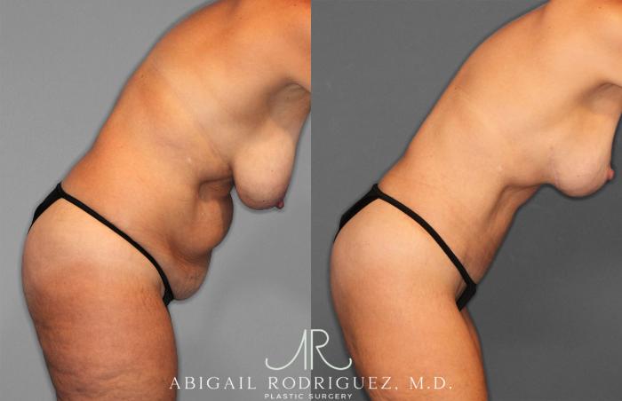 Before & After Tummy Tuck Case 258256 View 9 View in Houston, TX