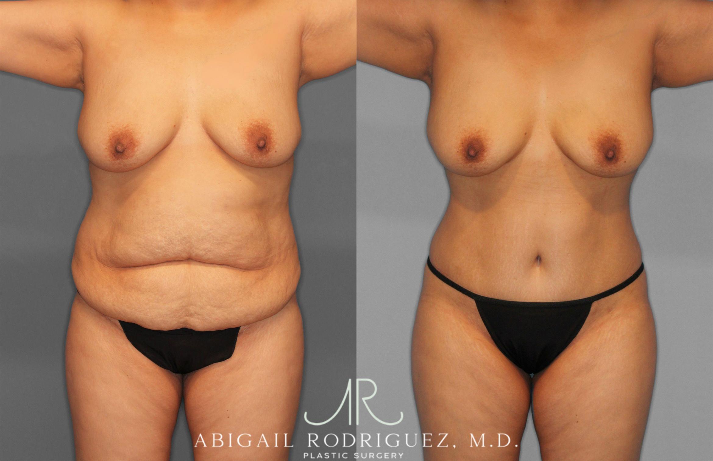 Before & After Tummy Tuck Case 258309 View 1 View in Houston, TX